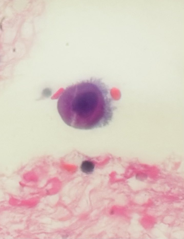 Too good to be true-never seen before such beautiful microvilli so apparent in a cell block of pleural fluid 
Lacy skirt of mesothelial cells -microvilli 9 times long as broad , making those esoteric windows of mesothelial cells