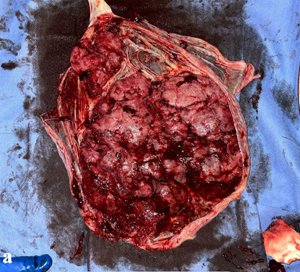 #Placental Pathways: A Case Report on Buprenorphine-Naloxone for Opioid Use Disorder and Placental Pathology
jcgo.elmerpub.com/index.php/jcgo…