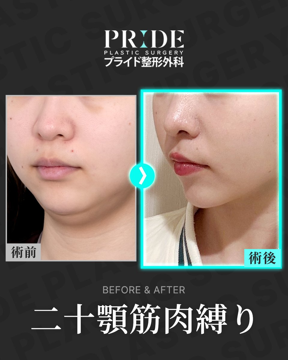prideseikei's tweet photo. ୨୧‥∵‥‥∵‥‥∵‥‥∵‥‥∵‥‥∵‥୨୧
PRIDE Before & After
୨୧‥∵‥‥∵‥‥∵‥‥∵‥‥∵‥‥∵‥୨୧

脂肪吸引だけでは解決できない、伸び切った筋肉の��るみを矯正するプライドの二十顎筋肉縛り🩵

こちらの症例は1か月後のお写真です👏

満足度がとても高い手術が現在
＼📢イベント価格中／

お気軽にお問い合わせください🙆‍♀️🩵
公式LINE🔎@prideps

#ペリカン手術 #顎下筋肉縛り #二十顎 #脂肪吸引 #二十顎脂肪吸引 #韓国 #整形 #渡韓 #韓国整形 #渡韓整形 #整形垢 #渡韓レポ #カウセレポ #整形垢さんと繋がりたい