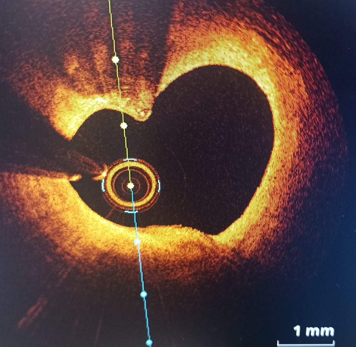 Jon Zubiaur Zamacola (@jonzubiaur) on Twitter photo Happy Valentine's day!
<a href="/secardiologia/">Soc Esp Cardiología</a> <a href="/shci_sec/">ACI-SEC: Hemodinamica</a> <a href="/CardioHULP/">Cardiología La Paz</a>
<a href="/JovenesSec/">JóvenesSEC</a>
#ValentinesDay #InterventionalCardiology #IntravascularImaging #OCT Happy Valentine's day!
<a href="/secardiologia/">Soc Esp Cardiología</a> <a href="/shci_sec/">ACI-SEC: Hemodinamica</a> <a href="/CardioHULP/">Cardiología La Paz</a>
<a href="/JovenesSec/">JóvenesSEC</a>
#ValentinesDay #InterventionalCardiology #IntravascularImaging #OCT