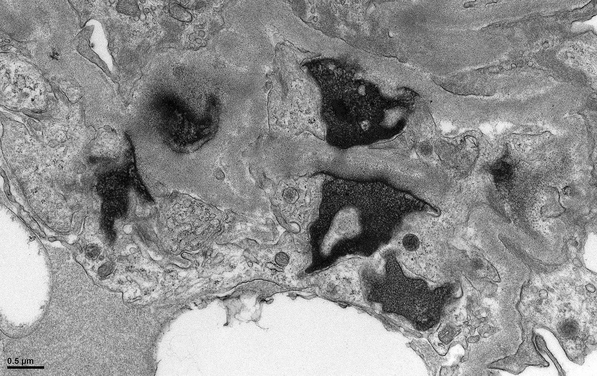 Native Kidney Bx #electronmicroscopy. #askrenal Any thoughts on these electron-dense structures? I interpret them as karyorrhectic debris. I see them rarely but have never seen them documented in an illustration. Interestingly this patient has 1+ C1q in capillary walls.