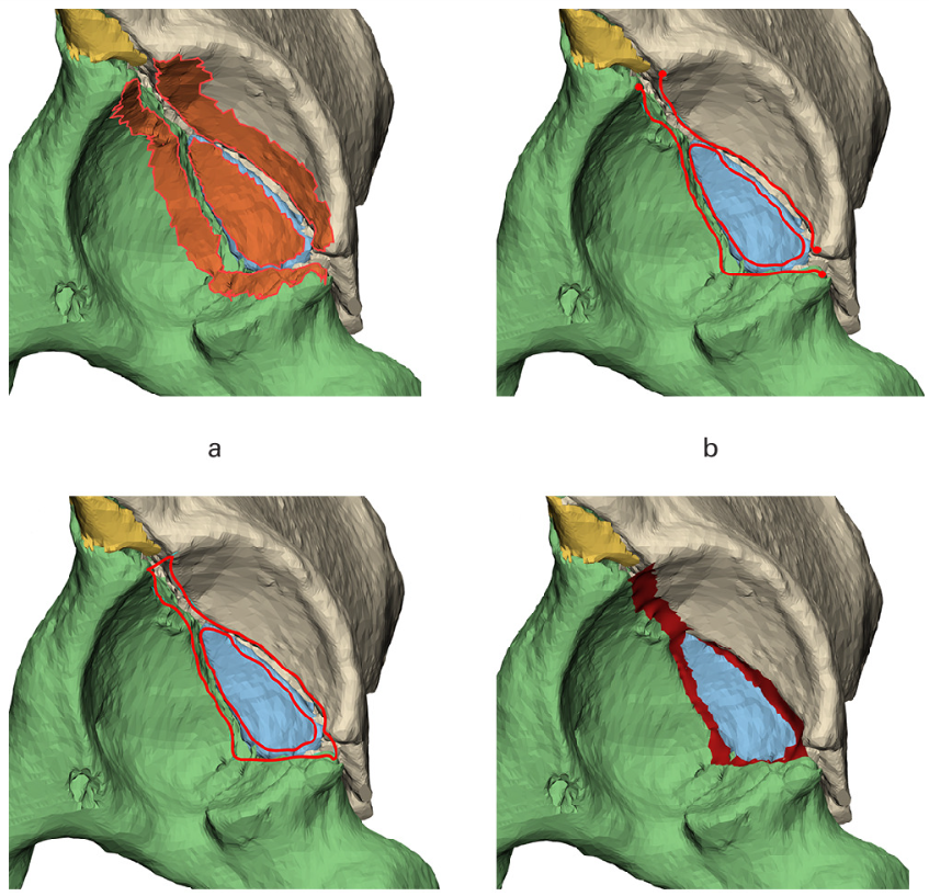 A multicentre, cross-sectional study was performed on 144 patients who were treated nonoperatively for an acetabular fracture in four level 1 trauma centres between January 2000 and December 2020.

#Trauma #Orthopedics #Hip

ow.ly/jgm850UQlHX