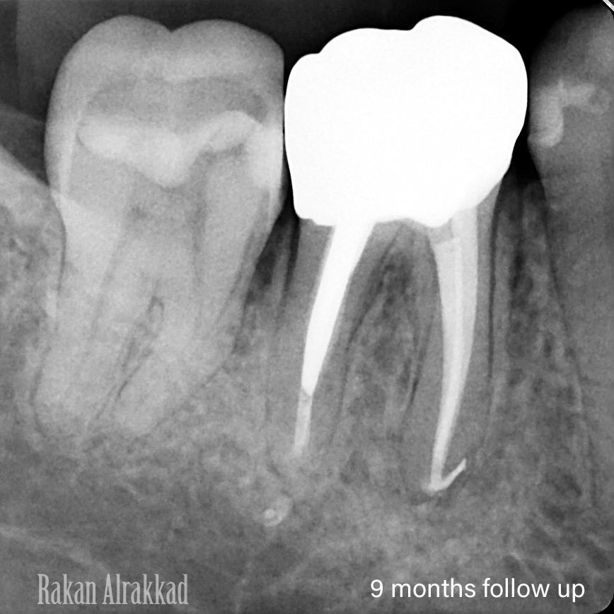 Save the tooth from extraction 🤝🏻

1st : Re-treatment 
2nd : Cast post &amp; core 
3rd : Surgical crown lengthening 
Finally: Zirconia crown 👑 

Follow up after 9 months and the lesion healed completely