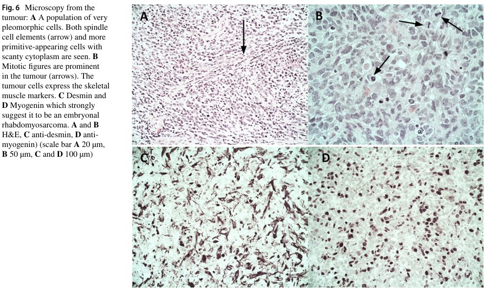 King's Neurosurgery (@kingsneuro) on Twitter photo A rare case of "Spinal rhabdomyosarcoma in a child at the site of a lumbosacral lipoma" published <a href="/SpringerNature/">Springer Nature</a> Child's Nerv. Sys
đź”—rdcu.be/d9RPk
<a href="/panduseetahal/">Pandu Seetahal</a> <a href="/BirlemBleil/">Cristina Birlem Bleil</a> <a href="/DifeiWang/">Difei Wang</a> <a href="/BasselZebian/">Bassel Zebian</a> <a href="/JulieNeuroRad/">Julie Chandra</a> A rare case of "Spinal rhabdomyosarcoma in a child at the site of a lumbosacral lipoma" published <a href="/SpringerNature/">Springer Nature</a> Child's Nerv. Sys
đź”—rdcu.be/d9RPk
<a href="/panduseetahal/">Pandu Seetahal</a> <a href="/BirlemBleil/">Cristina Birlem Bleil</a> <a href="/DifeiWang/">Difei Wang</a> <a href="/BasselZebian/">Bassel Zebian</a> <a href="/JulieNeuroRad/">Julie Chandra</a>