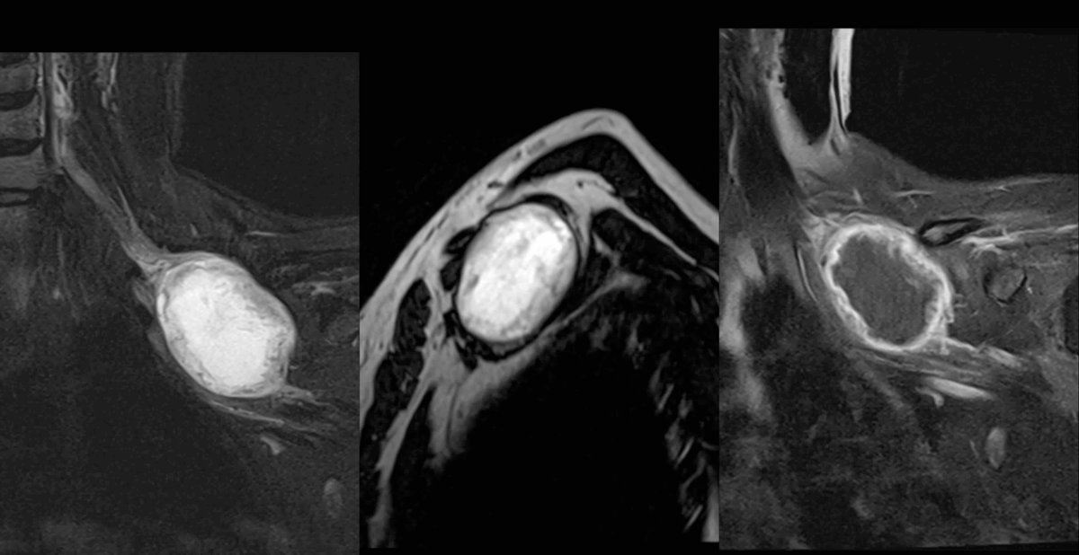 mehtanikhil's tweet image. Brachial Plexus Case:
40-year-old female, chronic left upper limb heaviness and tingling.
📌 MRI attached.
❓ What’s the likely diagnosis?
💡 Spot  characteristic imaging signs?
Drop your thoughts below! ⬇️
#NeuroImaging #Radiology #BrachialPlexus #MedTwitter #Neuroradiology