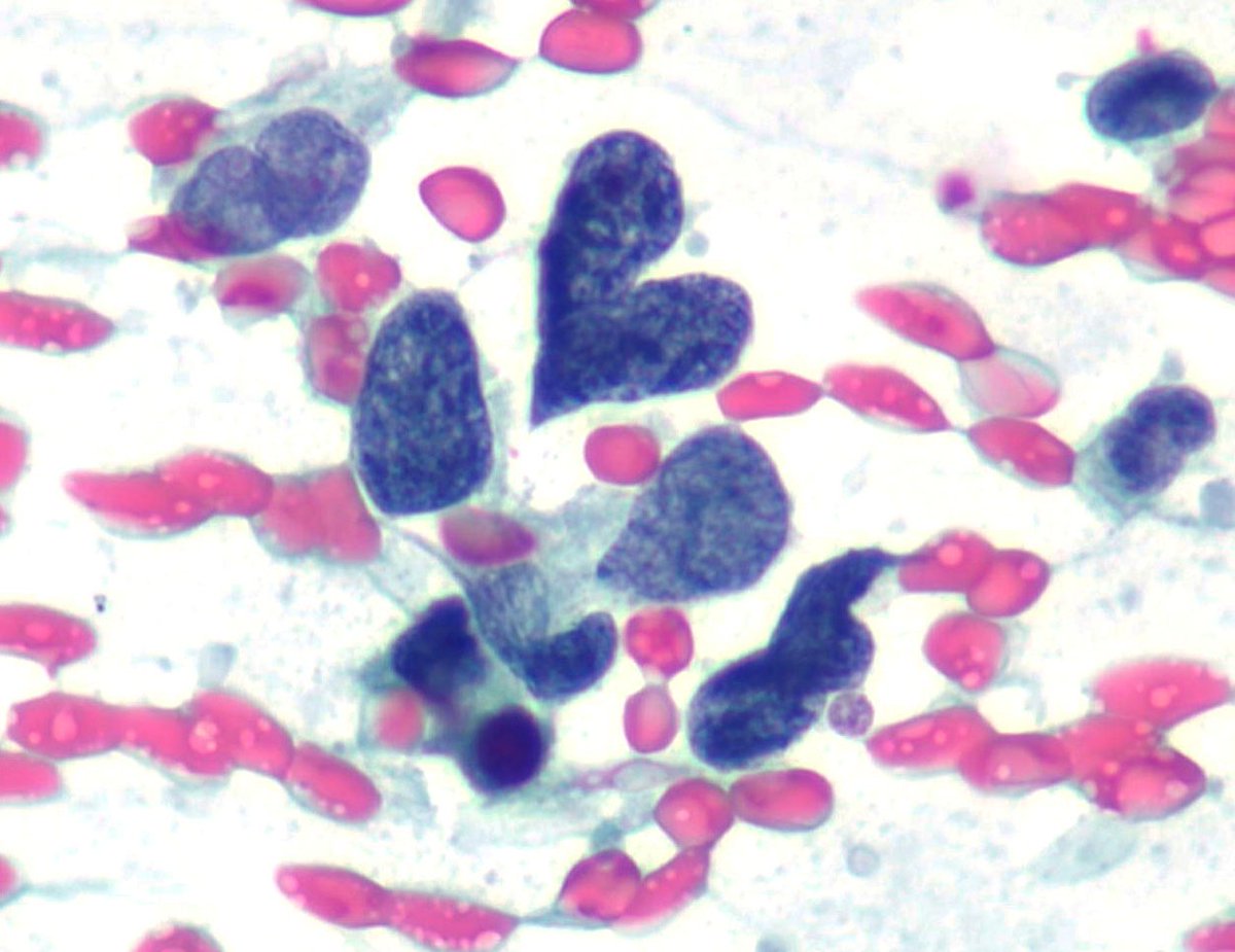 Lola Lozano (@mdlozanoe) on Twitter photo "Beautiful yet deadly heart". Small cell lung cancer
#Cytopath #LungPath <a href="/EfcsYoung/">Young EFCS</a> <a href="/IACytology/">International Academy Cytology</a> <a href="/SECitologia/">Sociedad Española de Citología</a> <a href="/SEAP_IAP/">SEAP-IAP</a> "Beautiful yet deadly heart". Small cell lung cancer
#Cytopath #LungPath <a href="/EfcsYoung/">Young EFCS</a> <a href="/IACytology/">International Academy Cytology</a> <a href="/SECitologia/">Sociedad Española de Citología</a> <a href="/SEAP_IAP/">SEAP-IAP</a>