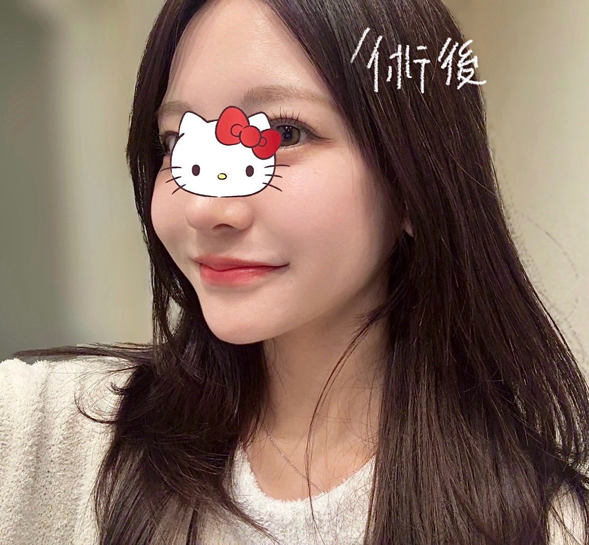 chinanago5656's tweet photo. 「ナチュラルだけど確実にリフトアップして小顔になりたい」っていう欲張り過ぎる要望を見事に叶えてくれた（ ;  ; ）
理想通りの仕上がりで毎朝化粧するのが楽しい😻 https://t.co/F2V3tQMLXz