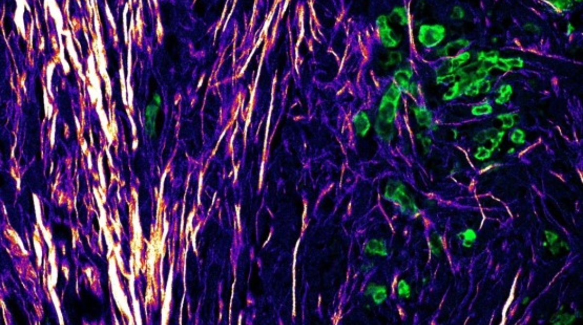 The ICR (@icr_london) on Twitter photo 📰 NEWS: ICR and <a href="/QMBCI/">Barts Cancer Institute (Queen Mary)</a> scientists have discovered the ‘roadmap’ that aggressive #Cancer uses to spread around the body – identifying ways to block its escape.
Read more about the research published in <a href="/NatureComms/">Nature Communications</a> ⤵️
icr.ac.uk/about-us/icr-n… 📰 NEWS: ICR and <a href="/QMBCI/">Barts Cancer Institute (Queen Mary)</a> scientists have discovered the ‘roadmap’ that aggressive #Cancer uses to spread around the body – identifying ways to block its escape.
Read more about the research published in <a href="/NatureComms/">Nature Communications</a> ⤵️
icr.ac.uk/about-us/icr-n…