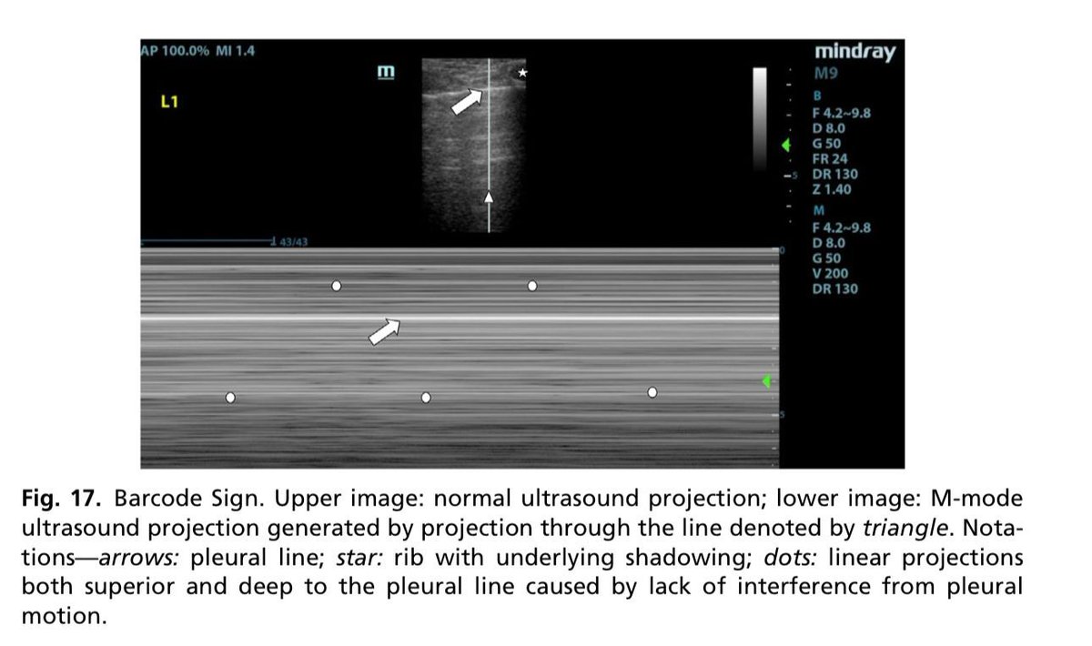 🩺🔊🩻 𝗘𝗰𝗼𝗴𝗿𝗮𝗳𝗶́𝗮 𝗱𝗲 𝗹𝗮 𝘃𝗶́𝗮 𝗮𝗲́𝗿𝗲𝗮 𝘆 𝗲𝗹 𝘁𝗼́𝗿𝗮𝘅: ¿𝗖𝗼́𝗺𝗼 𝘂𝘀𝗮𝗿𝗹𝗮 𝗲𝗻 𝗹𝗮 𝗽𝗿𝗮́𝗰𝘁𝗶𝗰𝗮 𝗰𝗹𝗶́𝗻𝗶𝗰𝗮?🫁🌬️
⬇️⬇️⬇️
Fuente: 𝘌𝘮𝘦𝘳𝘨𝘦𝘯𝘤𝘺 𝘔𝘦𝘥𝘪𝘤𝘪𝘯𝘦 𝘊𝘭𝘪𝘯𝘪𝘤𝘴 𝘰𝘧 𝘕𝘰𝘳𝘵𝘩 𝘈𝘮𝘦𝘳𝘪𝘤𝘢， 2024
👇🏼👇🏼👇🏼👇🏼👇🏼
🔗🔑🔓
