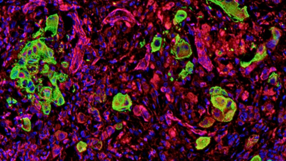 Barts Cancer Institute (Queen Mary) (@qmbci) on Twitter photo 📰 Scientists at BCI <a href="/QMUL/">Queen Mary University of London</a> and <a href="/ICR_London/">The ICR</a> have discovered a ‘roadmap’ that aggressive cancer uses to spread around the body and have identified ways to block its escape.
The findings could help doctors spot which tumours are likely to be aggressive⤵️
bci.qmul.ac.uk/general-news/2… . 📰 Scientists at BCI <a href="/QMUL/">Queen Mary University of London</a> and <a href="/ICR_London/">The ICR</a> have discovered a ‘roadmap’ that aggressive cancer uses to spread around the body and have identified ways to block its escape.
The findings could help doctors spot which tumours are likely to be aggressive⤵️
bci.qmul.ac.uk/general-news/2… .