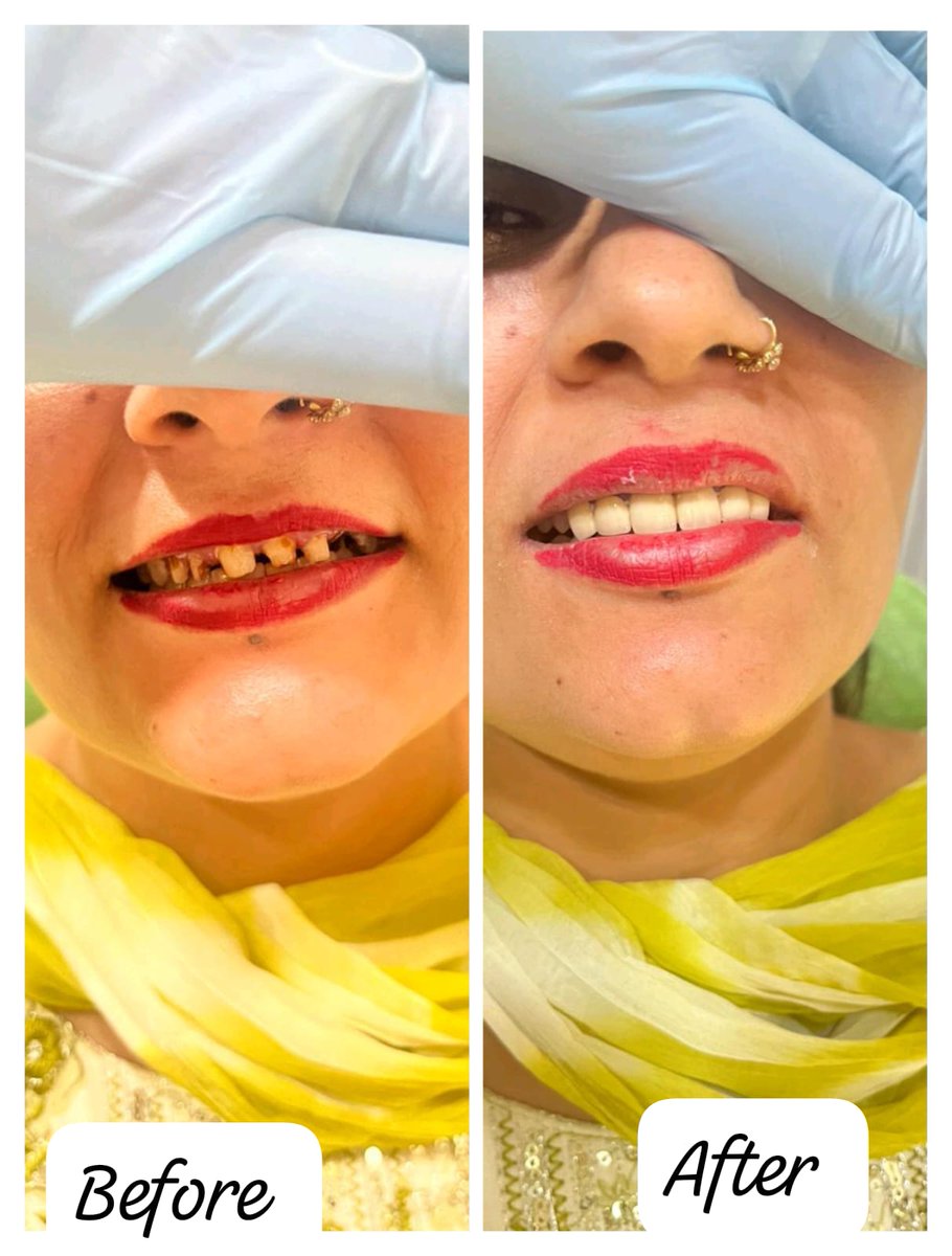 clinic_oberoi's tweet image. ➡️ Patient Success Story

Meet Our Patient – They Walked in with Dental Concerns and Walked out with a Brand-New, Confident Smile! see the Amazing Difference!

Book an Appointment - 📞 +91-9872197339 🌐 oberoidentalclinic.com

 #HappyPatient #DentistLife #TeethTransformation
