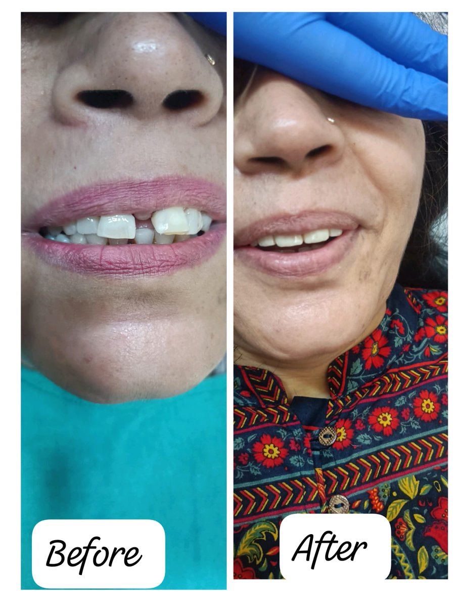 clinic_oberoi's tweet image. ➡️ Patient Success Story

Meet Our Patient – They Walked in with Dental Concerns and Walked out with a Brand-New, Confident Smile! see the Amazing Difference!

Book an Appointment - 📞 +91-9872197339 🌐 oberoidentalclinic.com

 #HappyPatient #DentistLife #TeethTransformation