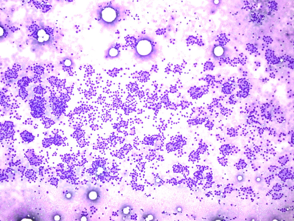 irem_onur_'s tweet photo. IS THIS A NICE FNA CASE OF THYROID FOLLICULAR NEOPLASM?
No. Prostatic adenocarcinoma metastatis to supraclavicular lymph node! PSAP (+) #FNA #thyroid #Diff_Quik #cytopath #cytology #cytopathology
@turkishcytopath https://t.co/zMF8ewud00