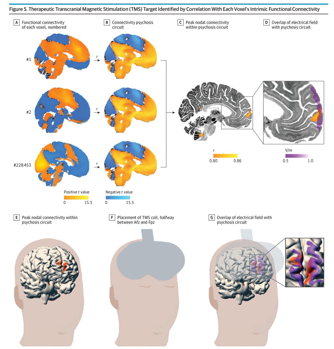 JAMA Psychiatry (@jamapsych) on Twitter photo This study identified a common brain circuit centered on the hippocampus's posterior subiculum linked to lesions causing secondary psychosis. ja.ma/4aZ0bEY <a href="/fredschaper_/">Frederic Schaper</a> <a href="/shansiddiqi/">Shan Siddiqi @shansiddiqi.bsky.social</a> This study identified a common brain circuit centered on the hippocampus's posterior subiculum linked to lesions causing secondary psychosis. ja.ma/4aZ0bEY <a href="/fredschaper_/">Frederic Schaper</a> <a href="/shansiddiqi/">Shan Siddiqi @shansiddiqi.bsky.social</a>