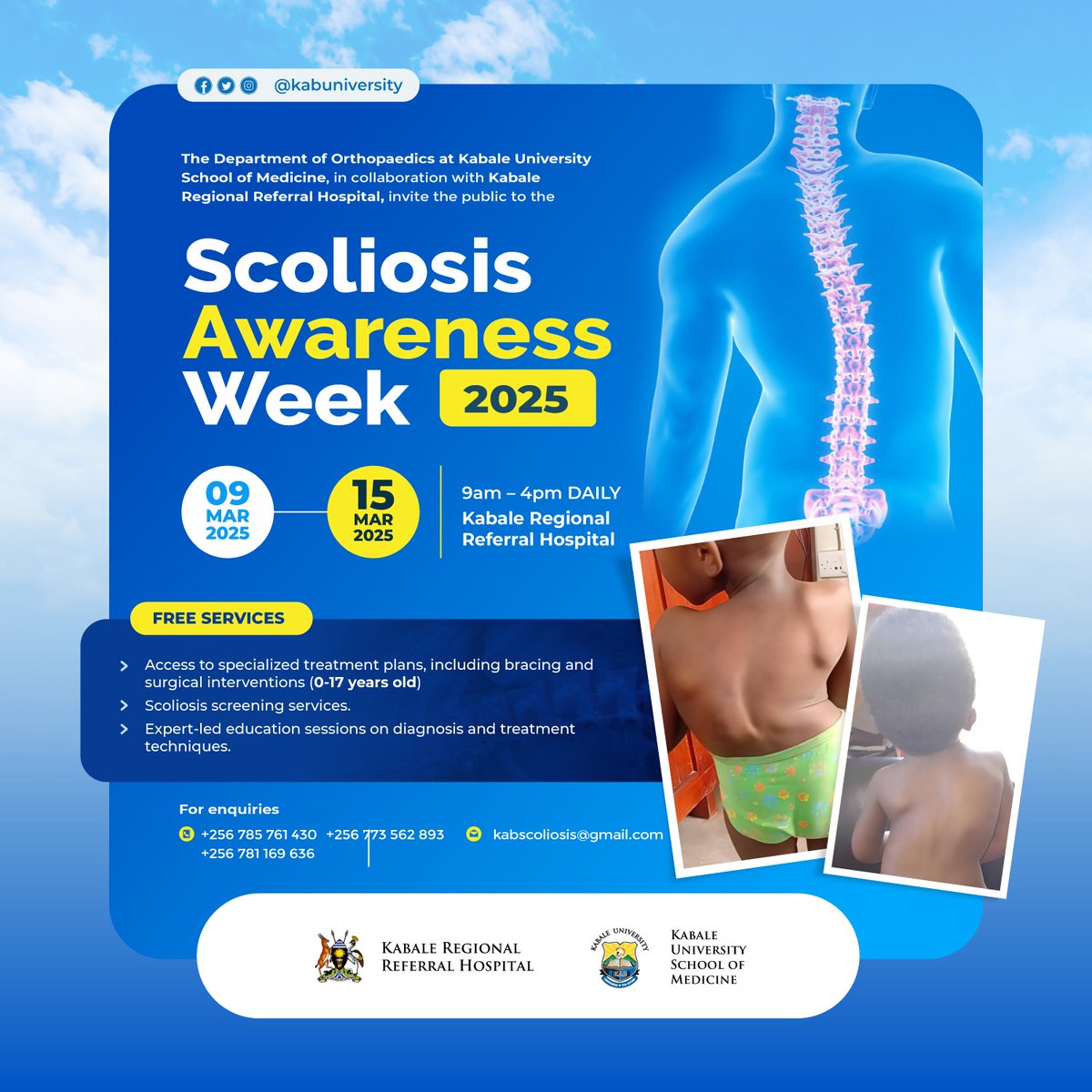 A life-changing opportunity for children (0-17 years) 
Led by Kabale University School of Medicine &amp; Kabale Regional Referral Hospital, this initiative aims to improve early diagnosis and treatment outcomes.

📍 Spread the word so those in need get help! #ScoliosisAwareness