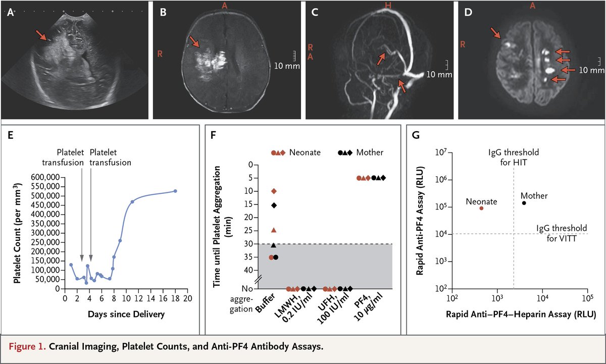 Maternal platelet-activating anti–platelet factor 4 antibodies led to cerebral venous sinus thrombosis, thrombocytopenia, hyperfibrinolysis, and cerebral bleeding in a neonate. Read the full correspondence: nej.md/3QbmHkt