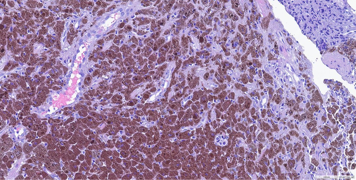 AliaksZhur's tweet photo. Melanosis of stomach, SOX10 negative. Patient with metastatic melanoma after immunotherapy #melanoma #GIpath https://t.co/TTIh0Eum7T
