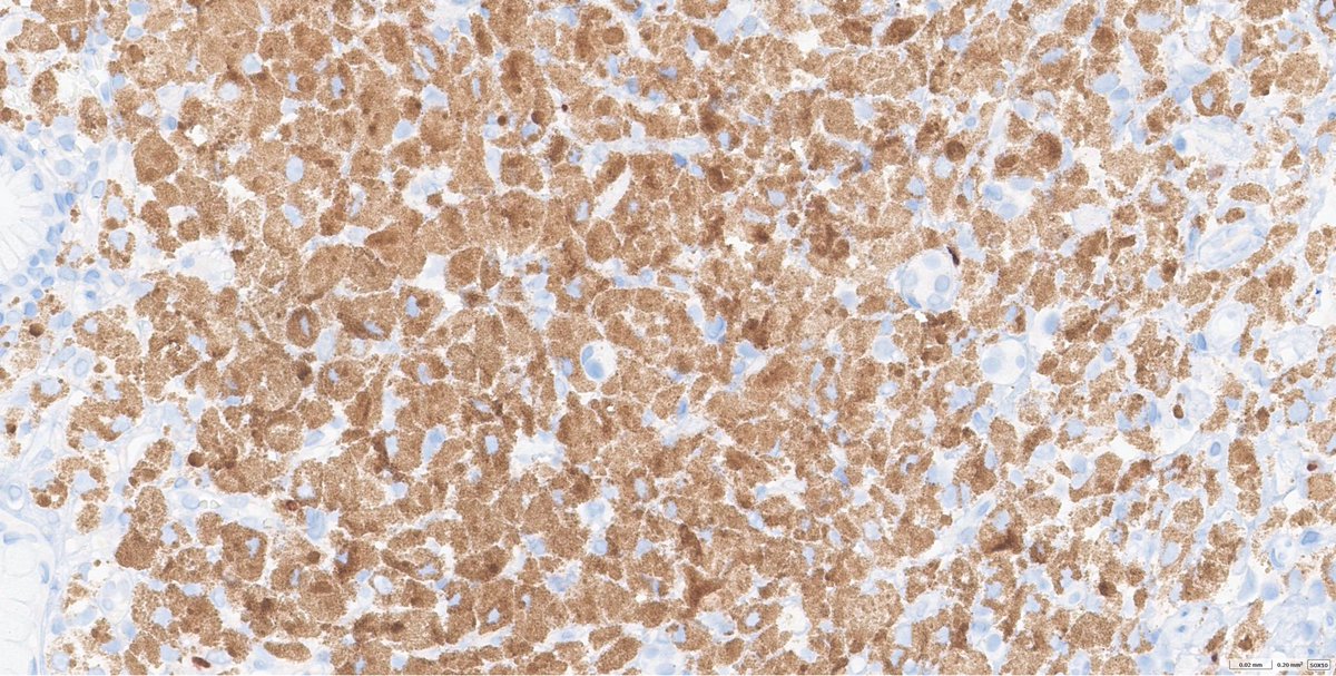 Melanosis of stomach, SOX10 negative. Patient with metastatic melanoma after immunotherapy #melanoma #GIpath
