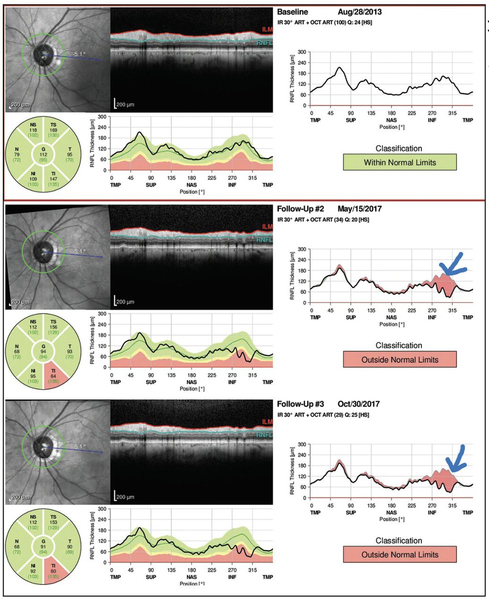 Tracking Glaucoma with OCT

Progression monitoring is an art. Here’s expert guidance for interpreting the data and avoiding pitfalls: reviewofophthalmology.com/article/tracki…
#ophthalmology #ophthalmologist #glaucoma