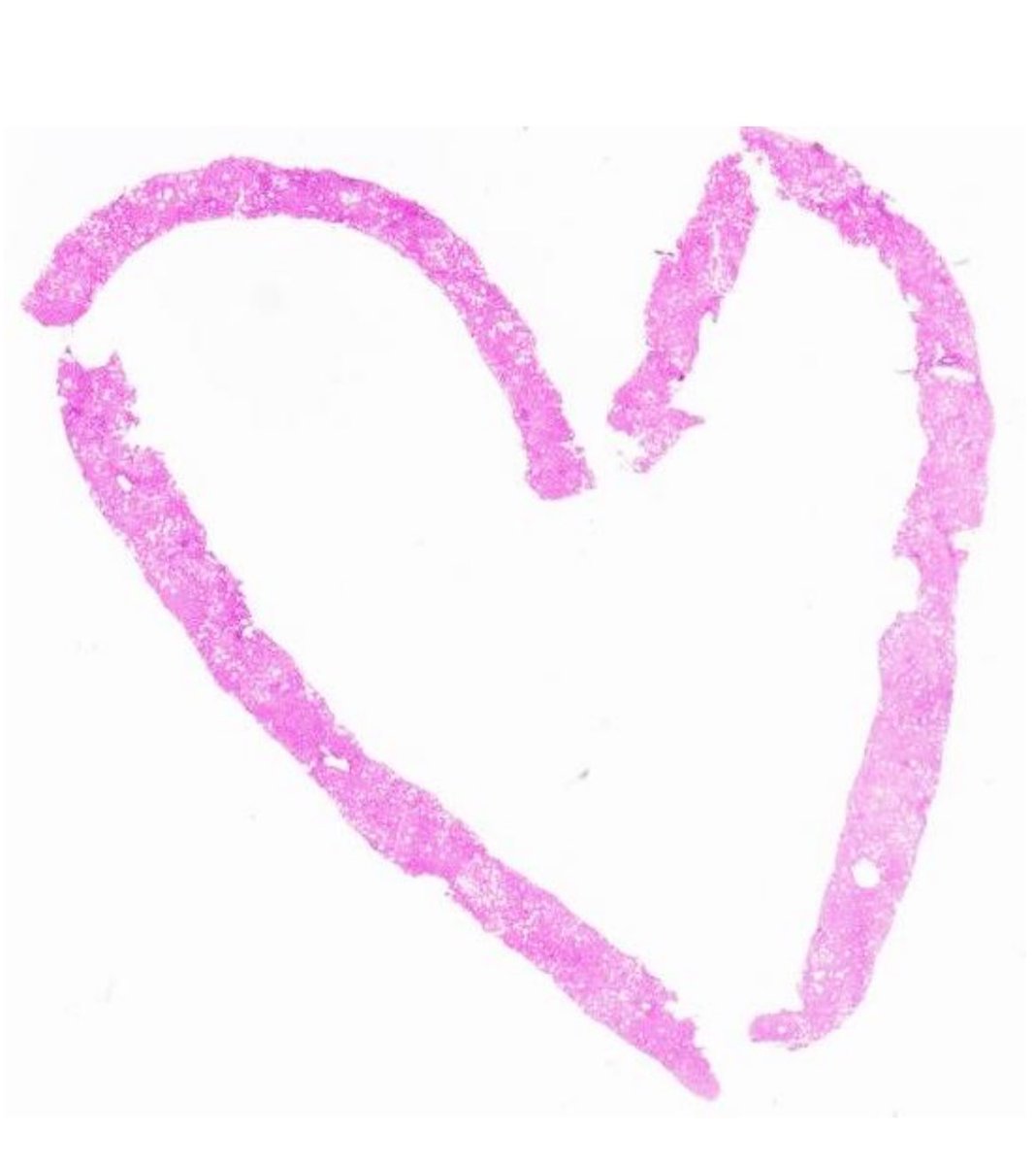 Dina Tiniakos (@dinatiniakos) on Twitter photo Happy Valentine’s Day to all #liver lovers out there!🔬 <a href="/ESP_Pathology/">European Society of Pathology (ESP)</a> <a href="/EASLnews/">EASLnews</a> <a href="/my_ueg/">my_UEG</a> <a href="/UKLiverPath/">UK Liver Pathology Group</a> <a href="/LiverPath_HPHS/">Hans Popper Hepatopathology Society</a> <a href="/eemh_hasl/">HASL</a> <a href="/SALVE_liver/">Study of Alcohol-related LiVer disease in Europe</a> <a href="/AASLDtweets/">AASLD</a> <a href="/LITMUS_IMI/">LITMUS_Project</a> <a href="/TheUSCAP/">USCAP</a> Happy Valentine’s Day to all #liver lovers out there!🔬 <a href="/ESP_Pathology/">European Society of Pathology (ESP)</a> <a href="/EASLnews/">EASLnews</a> <a href="/my_ueg/">my_UEG</a> <a href="/UKLiverPath/">UK Liver Pathology Group</a> <a href="/LiverPath_HPHS/">Hans Popper Hepatopathology Society</a> <a href="/eemh_hasl/">HASL</a> <a href="/SALVE_liver/">Study of Alcohol-related LiVer disease in Europe</a> <a href="/AASLDtweets/">AASLD</a> <a href="/LITMUS_IMI/">LITMUS_Project</a> <a href="/TheUSCAP/">USCAP</a>