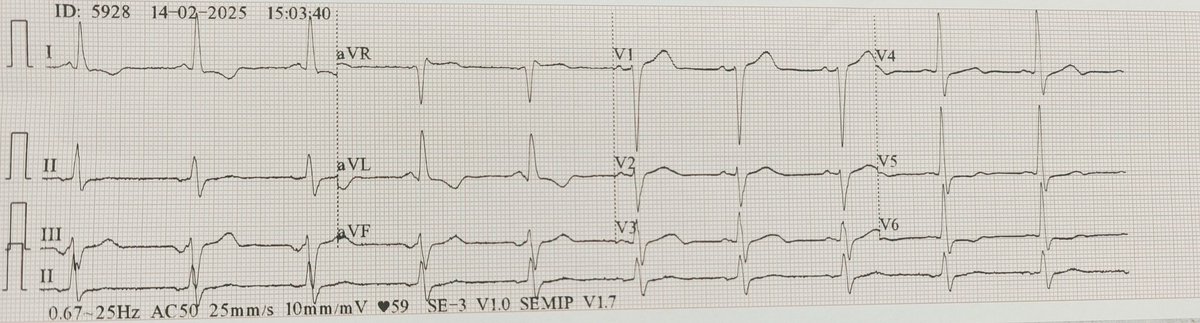 Patient: M 72y  PMH DM2 admitted to ER ,SOB, received amiodarone infusion <a href="/adribaran/">Adrian Baranchuk MD FACC FRCPC FCCS FSIAC</a> <a href="/ecgandrhythmRoe/">Dr. Andreas Roeschl</a> <a href="/MaruanCarlos/">Maruan C Chabbar</a> <a href="/The_Nanashi_O/">Nanashī🫀</a> <a href="/ecgrhythms/">Arnel Carmona</a> <a href="/syamkumarmd/">Syamkumar</a> <a href="/Serginho1409/">Sergio Moreno M</a> <a href="/UlhasDr/">Dr Ulhas Pandurangi</a> <a href="/DrRazi4/">Dr Razi</a> <a href="/Jagdish26039718/">Jagdish Singh</a> <a href="/EcgOxford/">🫀EcgOxford</a> <a href="/DidlakeDW/">David Didlake</a> <a href="/Doc_AleCuesta/">Alejandro Cuesta</a> <a href="/IhabFathiSulima/">Dr Ihab Suliman</a>