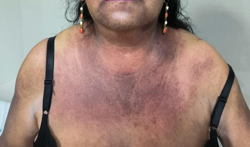 ConsejosReumato's tweet photo. Mujer de 54 años con #dermatomiositis , vean algunas lesiones dérmicas características como el  #rash en parte posterior del #cuello y #espalda (signo "del chal o manto") así como en cara anterior del #tórax . #myositis #ck #skin #myopathy #miopatía #gottron #heliotropo https://t.co/BdQkpJIcmV