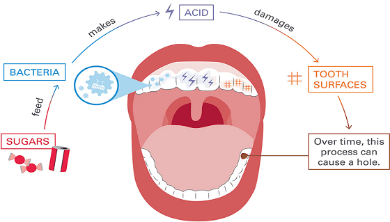 theNOBSdentist's tweet photo. The Peaty Guide to Dental Health

I have a lot of mutuals that are die hard peaters, and I’ve also gotten into some spats with many others. What most of you don’t know is that I get LOTS of messages that go kind of like this:

“So I’ve been following a peaty diet for the last year and I have a bunch of cavities. what do?"

I’m not here to persuade towards or away from a Peaty way of life, but you should be armed with the tools to avoid big bills at the dentist.

-Sugar & Acid: Minimize Contact, Maximize Remineralization

If you drink OJ, honey, or Mexican Coke, use a straw and rinse with water after.

You need to start thinking about sugar exposures in windows of 20 minutes. Sipping on one can of coke over 7 hours is way worse than chugging a 12 pack in 10 minutes (well, worse for your teeth).

Pair sugar with calcium. Keep calcium intake high (milk, cheese) to counteract demineralization. Ray himself has talked about this.

-Oral Environment: Keep It Alkaline

Rinse your mouth with baking soda water or an alkaline rinse after acidic foods.

Never brush immediately after citrus, black coffee, or soda—wait 30 minutes to prevent enamel erosion. I’ve spoken about this being an overemphasized rule, but a peaty diet flips this dynamic a bit. Definitely follow this rule with high sugar/acid.

Saliva is always the best defense. If you wake up with a dry mouth, your oral pH has been acidic all night—fix this before worrying about sugar intake. Explore mouth tape, or better yet, get a sleep study. Combine dry mouth with sugar, you're TOAST.

In the same vein: nasal breathing is essential. Mouth breathing dries the mouth, shifting the oral environment towards a low pH. Many people mouth breathe during the day, not just at night.

To be honest, if you’re mouth breathing and have dry mouth, the metabolic benefits of a peaty diet should take a backseat to getting that under control anyway.

-Oral Hygiene

Use nano-hydroxyapatite toothpaste (like NOBS, sorry for the shameless plug) to remineralize teeth instead of fluoride.

Brush with EXTRA soft bristles to avoid enamel erosion.

Xylitol, Xylitol, Xylitol…and maybe some more xylitol. You’re going to need every ounce of strength against streptococcus mutans. You’re going to need as much help as you can stimulating saliva production to counter the acid. Lots of xylitol gum and mints.

Here’s something you might not expect from me: a Peaty diet raises an interesting conundrum. The thyroid is uniquely susceptible to fluorine, but a peaty diet might fare well with fluoride-fortified enamel. The mechanism of action would provide significant protection against the acid attacks on the teeth. My framework would be to start using fluoridated toothpaste if you’re peating and see a big uptick in cavities and acid erosion until you can get things under control.

-Minerals & Nutrition: A caution

Almost every peater places a heavy emphasis on vitamin K2 as a magic bullet against cavities. The reality is that it’s important and underappreciated for the average person, but peater’s swing too hard in the opposite direction.

No amount of K2 will save teeth that are constantly bathed in acidic, fermentable food debris.

K2 is extremely important for jaw bone health and mineral shuttling for saliva and subsequent tooth health. You’re probably less K2 deficient than you think, and occam’s razor will likely apply to the cause behind the decay.

-Circadian Rhythm

I won’t overstep here and pretend to be a circadian expert, but Vitamin D is an important aspect of oral health. Fix your sun exposure, and blue light environment.

-Don’t just blame the Wheat Germ

Ray loved to blame his dental issues on wheat germ. Don’t fall for the meme. Sure, it may have contributed to the issue but what if it was simpler than that? Move and act as if the wheat germ story wasn’t told. There are plenty of people on the forums who are suffering from rampant cavities that aren’t limited to a wheat germ diet.

Many of these things were discussed by Peat himself, but some of them rely on the basic principles of good oral health. In fact, it's hardly any different from my usual insights...it's just less focused on "cut out sugar". 

I’m not here to advise you towards a certain type of metabolic framework, but if you’re going to follow a peaty lifestyle you should not let your oral health slip as many have. It happens pretty damn quickly.