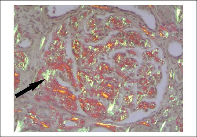 JasmineNephro's tweet image. 🍏Amyloidosis-Apple green appearance under 🔬

👍Salmon pink on Congo red

👍Apple green under polarising microscope 

#Nephropath 

By Dr Arvind at #NZISN @PGINEPHRO