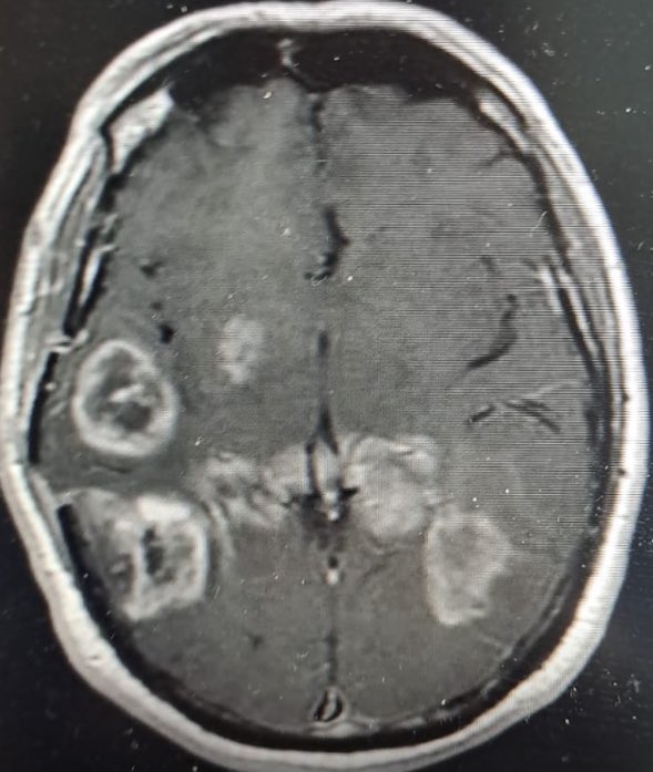 Imagen cerebral de un paciente sin rumbo, alguien con nombre, un doliente de un tumor cerebral que progresó por ausencia de tratamiento debido a restricciones del sistema sanitario. Tres meses esperando la radioterapia e imposibilidad para lograr la quimioterapia. Una lucha de