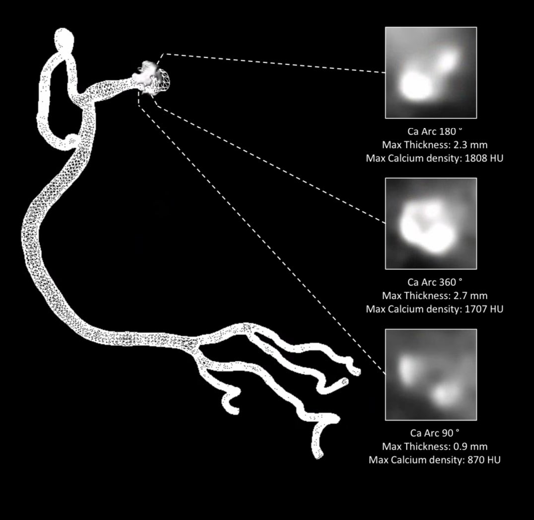 Carlos Collet MD PhD (@colletcarlos) on Twitter photo CT guided PCI Planning in #P4
🎯 Ostial RCA with thick, circumferential calcium (HU > 1.5k).
Plan:
🎬 AL 0.75 guiding for anterior take off
♟️IVL ostial RCA
📏 Stent 32 mm to cover the complete plaque
<a href="/jcspratt/">jcspratt</a> <a href="/yadersandoval/">Yader Sandoval</a> <a href="/esbrilakis/">Emmanouil Brilakis</a> <a href="/PCRonline/">PCRonline 🫀</a> <a href="/ziadalinyc/">Ziad Ali</a> <a href="/TCTMD/">TCTMD</a> CT guided PCI Planning in #P4
🎯 Ostial RCA with thick, circumferential calcium (HU > 1.5k).
Plan:
🎬 AL 0.75 guiding for anterior take off
♟️IVL ostial RCA
📏 Stent 32 mm to cover the complete plaque
<a href="/jcspratt/">jcspratt</a> <a href="/yadersandoval/">Yader Sandoval</a> <a href="/esbrilakis/">Emmanouil Brilakis</a> <a href="/PCRonline/">PCRonline 🫀</a> <a href="/ziadalinyc/">Ziad Ali</a> <a href="/TCTMD/">TCTMD</a>