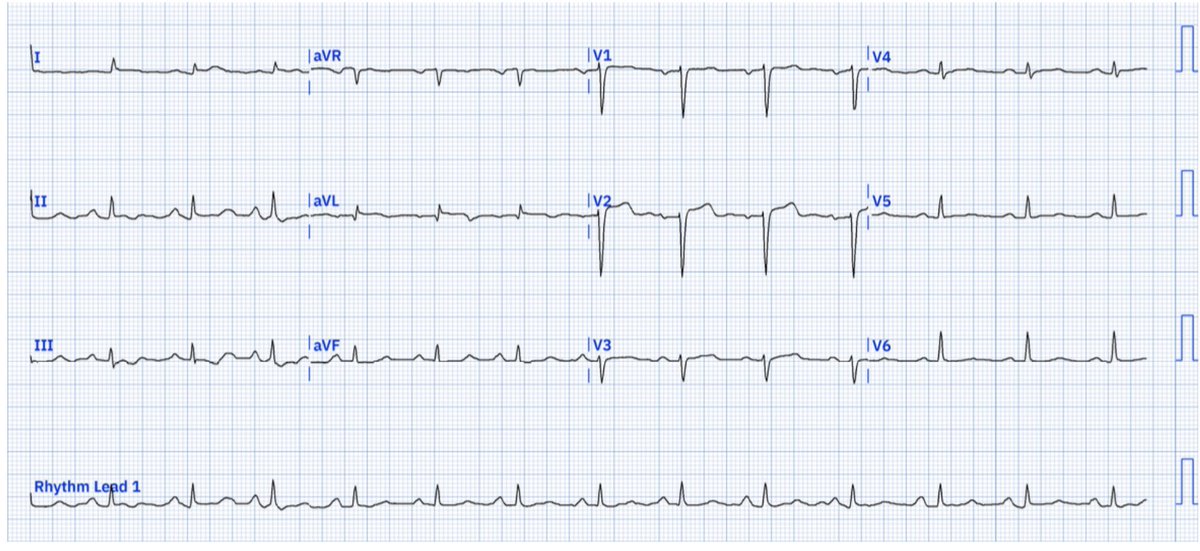 I got called an idiot in front of 4 other med students for calling this an MI…

I still believe this is going to be a LAD-D1 occlusion. I wont find out for a few days…

What are your thoughts?

#ECG #ECGChallenge #Medstudent