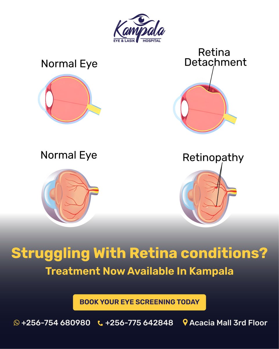 Understanding Retina Conditions 👁️
What are retina conditions?
The retina is the light-sensitive layer at the back of your eye that captures images. When damaged, your vision can be severely affected or even lost permanently.

Common Retina Conditions:

Retina Detachment
•