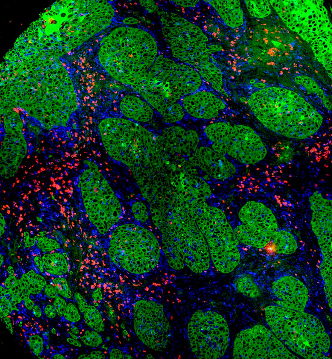 Matt Vesely MD, PhD FAAD (@mdvesely) on Twitter photo 🚨 New Target for cSCC Immunotherapy! 🚨
Immune checkpoint VISTA, linked to strong T cell activation in cutaneous SCC <a href="/theJIDJournal/">Journal of Investigative Dermatology</a>
#CancerResearch #Immunotherapy #VISTA #cSCC #immunecheckpoint #Oncology #skincancer #dermatology <a href="/YaleCancer/">Yale Cancer Center</a> <a href="/yalederm/">Yale Dermatology</a>
jidonline.org/article/S0022-… 🚨 New Target for cSCC Immunotherapy! 🚨
Immune checkpoint VISTA, linked to strong T cell activation in cutaneous SCC <a href="/theJIDJournal/">Journal of Investigative Dermatology</a>
#CancerResearch #Immunotherapy #VISTA #cSCC #immunecheckpoint #Oncology #skincancer #dermatology <a href="/YaleCancer/">Yale Cancer Center</a> <a href="/yalederm/">Yale Dermatology</a>
jidonline.org/article/S0022-…