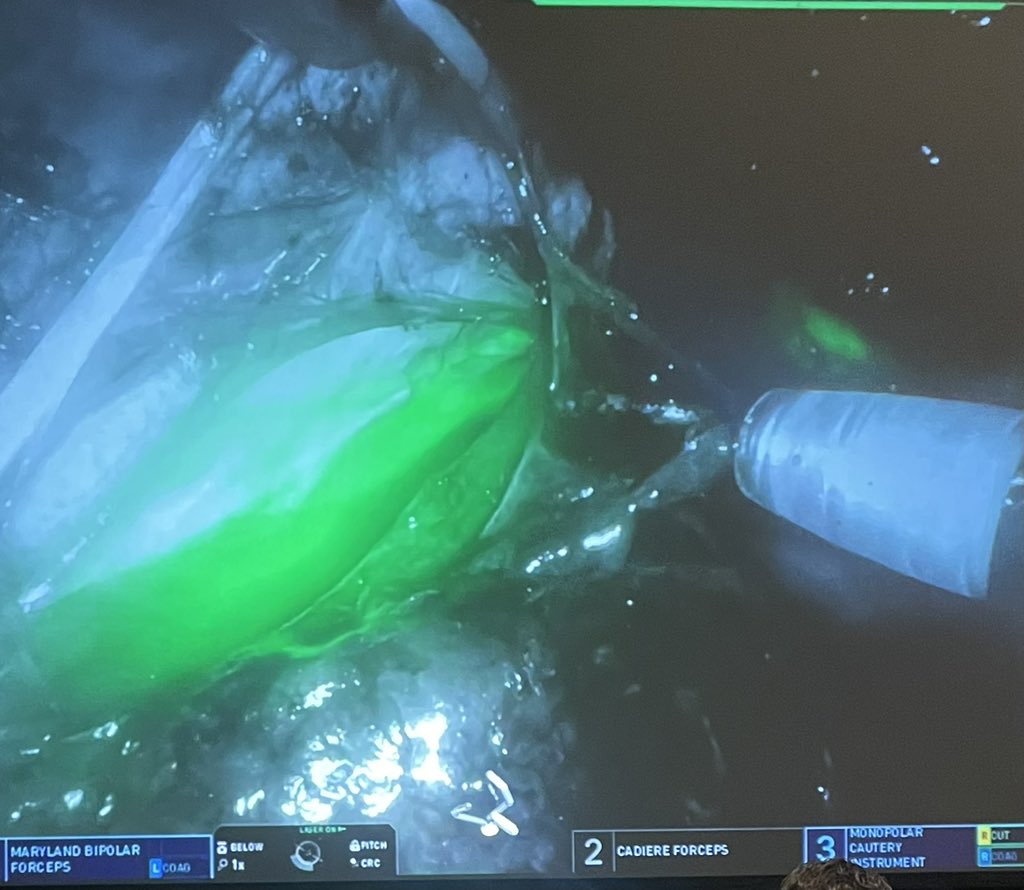 Ricardo Soares (@soares_uro) on Twitter photo Impressive video of simultaneous pyeloplasty with transposition of UPJ + side-to-side ureteral reimplant by <a href="/ZLeeGU/">Ziho Lee</a> <a href="/NM_Urology/">NM Urology</a>
- Retroperitoneal access avoids hostile abdomen; able to access ureter from bladder to UPJ
- distal ureterolysis
- use of ICG
<a href="/RoboUro/">North American Robotic Urology Society | NARUS</a> #narus2025 Impressive video of simultaneous pyeloplasty with transposition of UPJ + side-to-side ureteral reimplant by <a href="/ZLeeGU/">Ziho Lee</a> <a href="/NM_Urology/">NM Urology</a>
- Retroperitoneal access avoids hostile abdomen; able to access ureter from bladder to UPJ
- distal ureterolysis
- use of ICG
<a href="/RoboUro/">North American Robotic Urology Society | NARUS</a> #narus2025