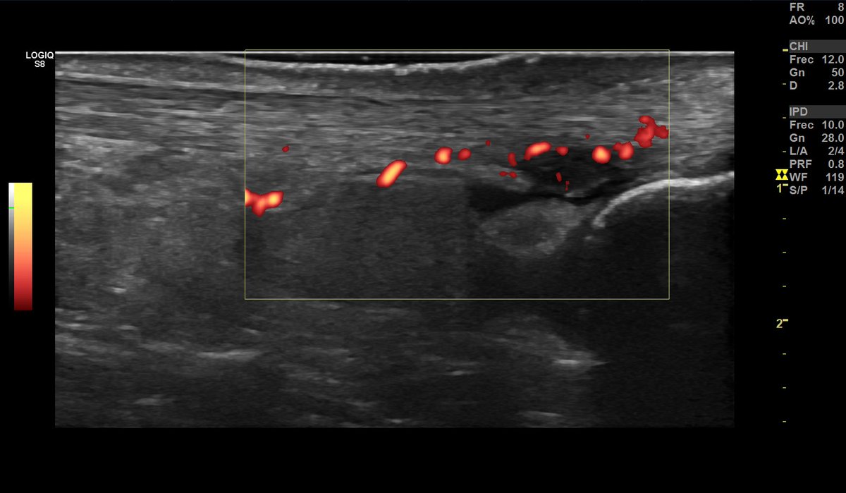 Carlosguillenas's tweet photo. Tendón de Aquiles: ¿Tendinosis? ¿Entesitis? ¿Rotura fibrilar? 
Grandes implicaciones a la hora de establecer un diagnóstico ecográfico. https://t.co/5vXDCSsGqA