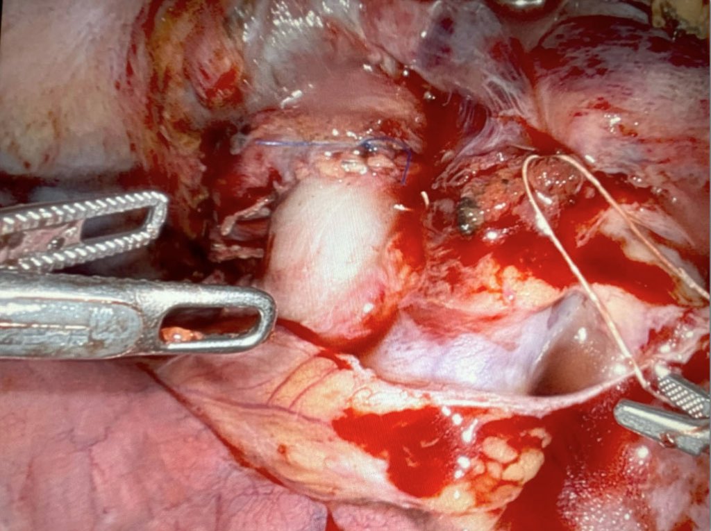 DukeCTSurgery (@dukectsurgery) on Twitter photo Announcing our first robotic lung transplant! A terrific <a href="/DukeHealth/">Duke Health</a> team effort, including <a href="/DukeSurgery/">Duke Surgery</a>, <a href="/Duke_Anesthesia/">Duke Anesthesiology</a>, <a href="/DukePACC/">Duke Pulmonary Allergy and Critical Care</a> and nursing. Indebted to our generous donor. Congrats to all - especially our rockstar patient! Photos with permission. Announcing our first robotic lung transplant! A terrific <a href="/DukeHealth/">Duke Health</a> team effort, including <a href="/DukeSurgery/">Duke Surgery</a>, <a href="/Duke_Anesthesia/">Duke Anesthesiology</a>, <a href="/DukePACC/">Duke Pulmonary Allergy and Critical Care</a> and nursing. Indebted to our generous donor. Congrats to all - especially our rockstar patient! Photos with permission.