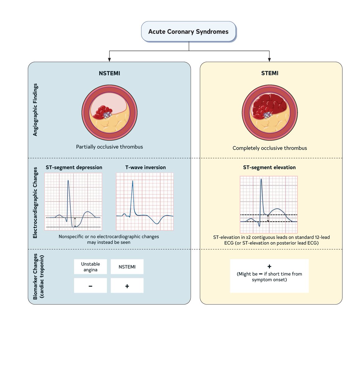 Published today with @ACCintouch, the 2025 Guideline for the Management of Patients With Acute Coronary Syndromes (ACS).

Endorsed by: <a href="/EmergencyDocs/">Emergency Physicians</a> <a href="/NAEMSP/">NAEMSP</a> <a href="/SCAI/">SCAI</a>

📷 Types and Classification of ACS