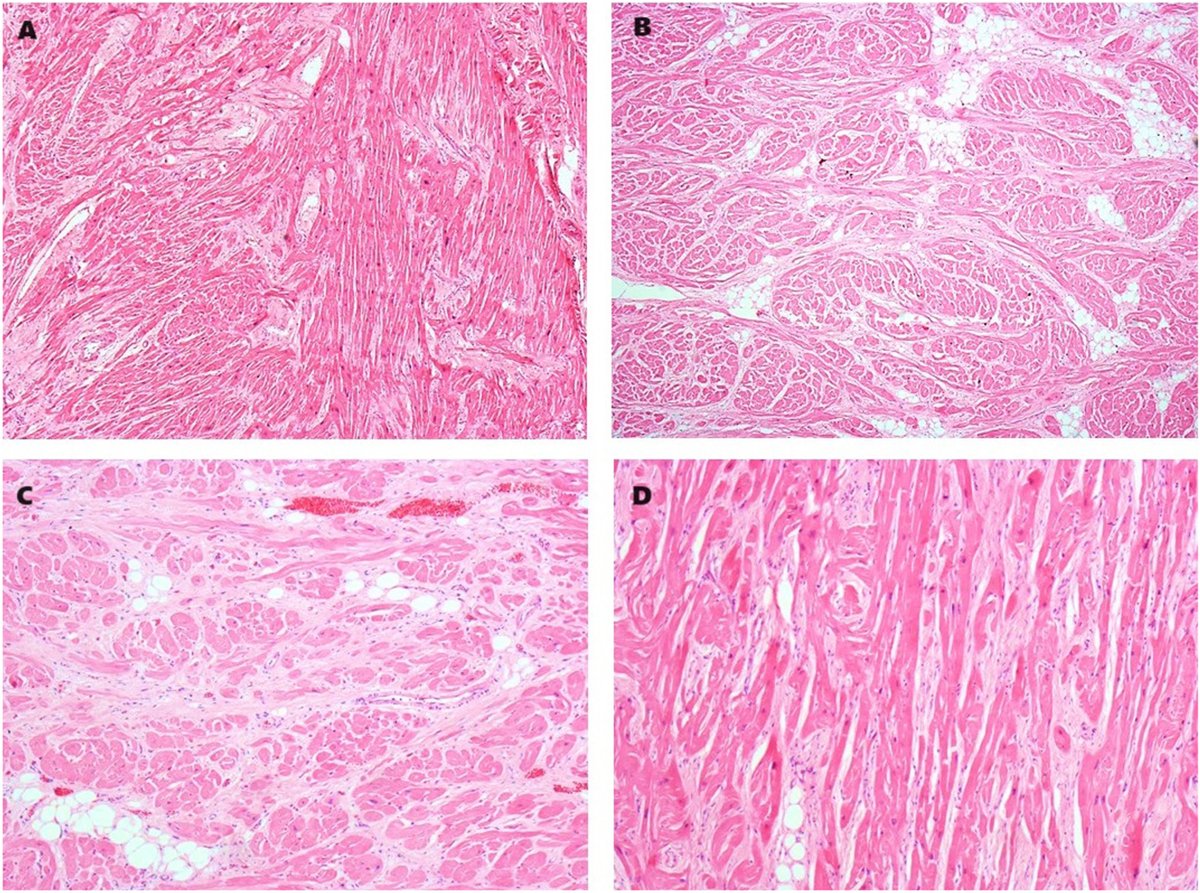 Beyond the postmortem diagnosis of hypertrophic cardiomyopathy: a genetic approach guided by clinical and morphological features in Noonan syndrome. #REC #Aheadofprint <a href="/esola_cardio/">Elena Sola-García</a>
revespcardiol.org/en-beyond-the-…