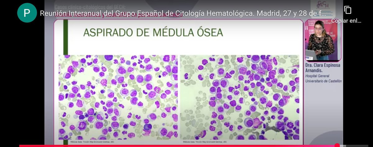 HematoGenCs's tweet photo. Esta tarde nuestra residente de cuarto año Clara Espinosa de @HematoGenCs y @GVAdepsalutcs , ha expuesto un caso clínico seleccionado entre los casos finalistas del Grupo Español de Citología Hematologica (GECH). Enorme Clara, seguro que vas al Nacional
#pedazoequipo
#GECH https://t.co/OgMwc7Bz7E
