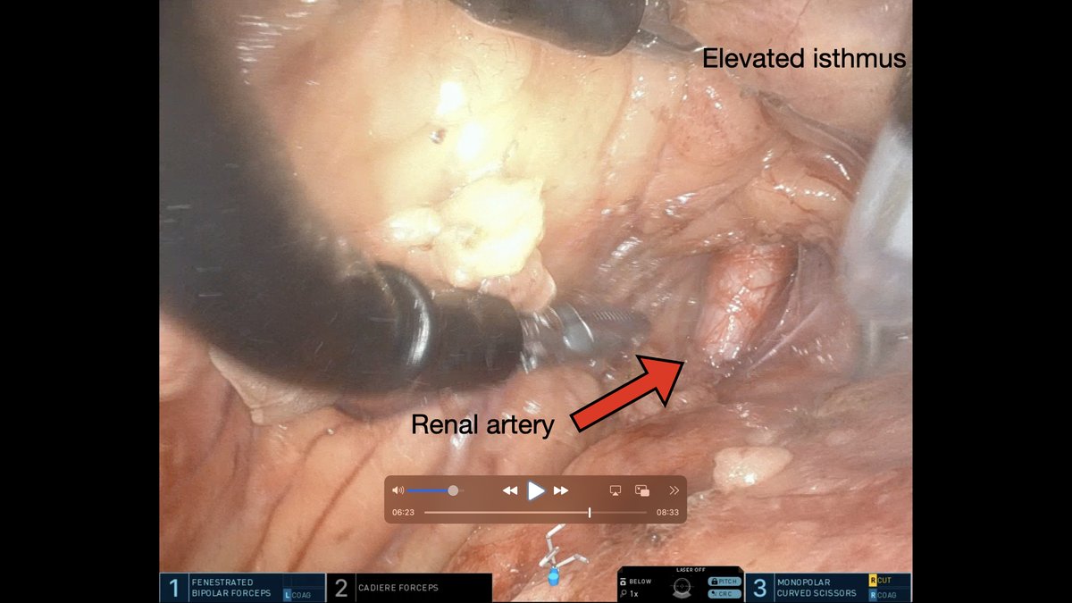 Low anterior retro SP access for endophytic anterior tumor in horseshoe kidney. Selective clamping showing perfused isthmus and lower pole during resection. Versatility of easily lifting the isthmus and approaching vessels posteriorly and then immediately shifting to anterior