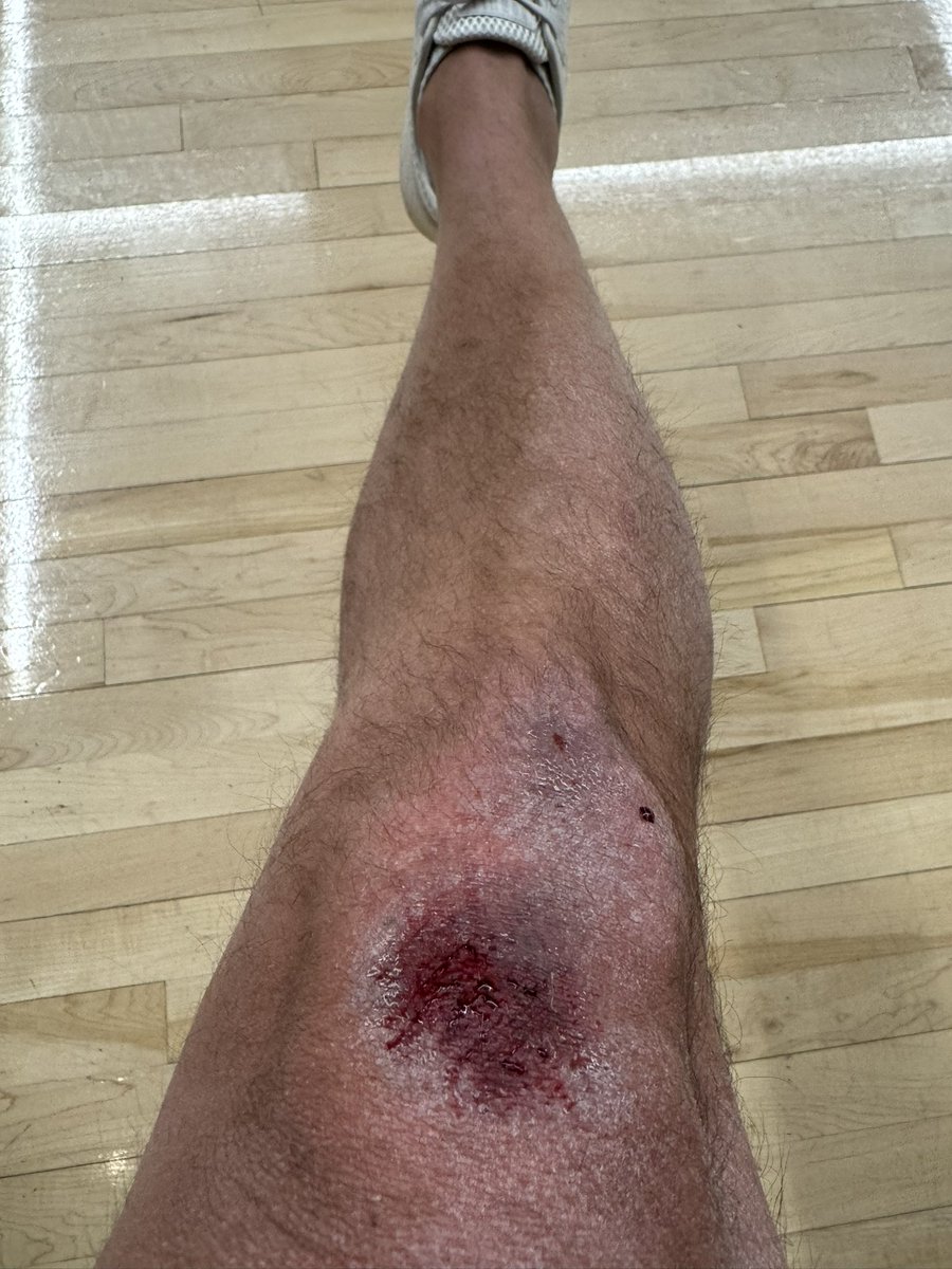 BarstoolBigCat's tweet photo. Lot of people asking if I’m withdrawing. I’ll never withdraw. Have to fight through it even if I might need my leg amputate. #12ThYear https://t.co/fCE7lCVrKE