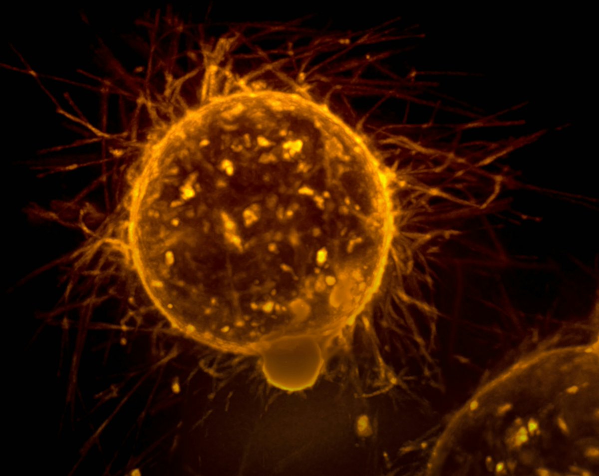 Interesting new research suggests that microglial activation can promote #melanoma brain metastasis.   Therefore, microglial reprogramming has the potential to enhance antitumour immunity and improve responses to immunotherapy. bit.ly/42JM6Jt