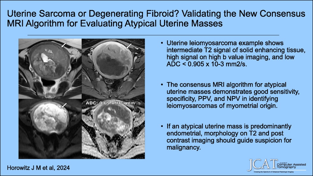 Eric Tamm, MD (@etammmd) on Twitter photo "New <a href="/JCATonline/">JCAT Online</a>
'Uterine Sarcoma or Degenerating Fibroid? Validating the New Consensus Magnetic Resonance Imaging Algorithm for Evaluating Atypical Uterine Masses'
Jan/Feb 25 dlvr.it/THSMb0 Au: Jeanne Horowitz et al. <a href="/Jeanne_Horowitz/">Jeanne Horowitz</a> <a href="/cammy_lv/">Camila LV</a> <a href="/AnugayathriJ/">Anugayathri Jawahar</a>,<a href="/NURadiology/">Northwestern Radiology</a> "New <a href="/JCATonline/">JCAT Online</a>
'Uterine Sarcoma or Degenerating Fibroid? Validating the New Consensus Magnetic Resonance Imaging Algorithm for Evaluating Atypical Uterine Masses'
Jan/Feb 25 dlvr.it/THSMb0 Au: Jeanne Horowitz et al. <a href="/Jeanne_Horowitz/">Jeanne Horowitz</a> <a href="/cammy_lv/">Camila LV</a> <a href="/AnugayathriJ/">Anugayathri Jawahar</a>,<a href="/NURadiology/">Northwestern Radiology</a>