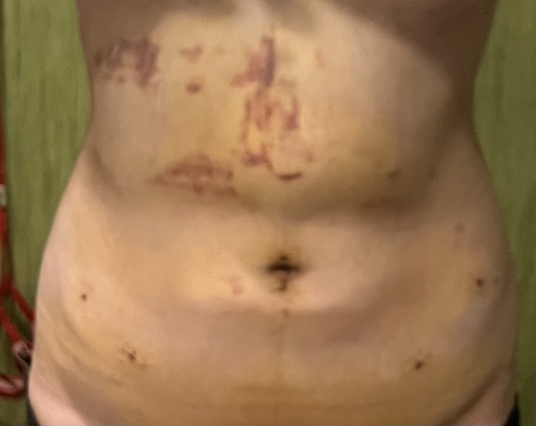 dt８日目
体重が−１キロ
2段になってるのが気になる
でも確実に昨日より細い💯
まだ筋肉痛のような痛みはあって
痛み止めは毎日3回飲んでます。
抗生剤は今日で終わり🙂
朝イチ40分ウォーキングも週3は
行けるように頑張ります✨✨
#脂肪吸引　#整形　#韓国　#dt  #エッジラインクリニック