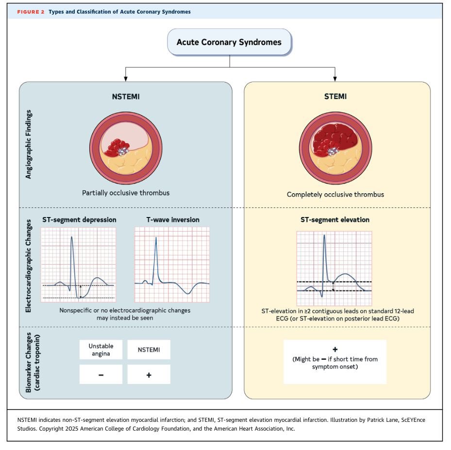 ECGcases's tweet photo. Unfortunately these guidelines repeat the same graphic from 20 years ago that STEMI/NSTEMI differentiates occlusion from non occlusive MI. But the 2022 ACC expert consensus states, #STEMI  “miss a significant minority of patients who have acute coronary occlusion” #CardioTwitter https://t.co/qrdf8Q8Omx