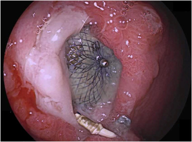 VideoGIE Journal (@videogie) on Twitter photo VideoGIE Editor's Choice: “Endoscopic closure of esophageal, gastric, jejunal, and rectopelvic fistulas with cardiac septal occluder devices: a case series” by Ethan M. Cohen et al. videogie.org/article/S2468-…
#GITwitter
<a href="/shailsingh/">Shailendra Singh</a> <a href="/EthanCohenMed/">Ethan M. Cohen, MD</a>
<a href="/KaraRaphael/">Kara Raphael</a> VideoGIE Editor's Choice: “Endoscopic closure of esophageal, gastric, jejunal, and rectopelvic fistulas with cardiac septal occluder devices: a case series” by Ethan M. Cohen et al. videogie.org/article/S2468-…
#GITwitter
<a href="/shailsingh/">Shailendra Singh</a> <a href="/EthanCohenMed/">Ethan M. Cohen, MD</a>
<a href="/KaraRaphael/">Kara Raphael</a>