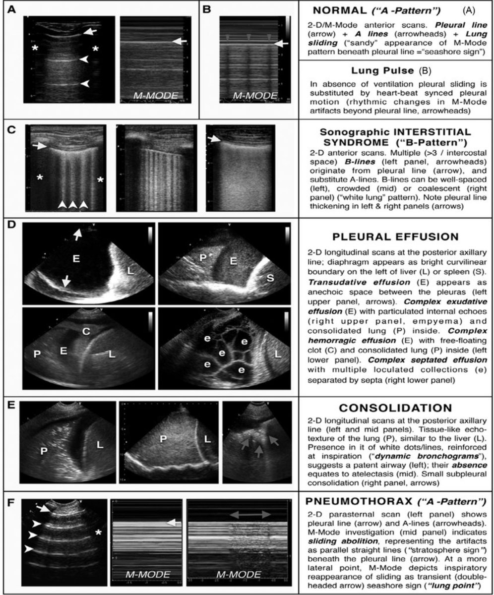 Lung ultrasound findings