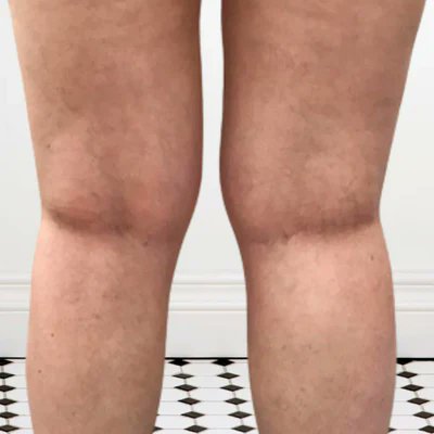 Helenanelson16's tweet image. Say goodbye to discomfort with Leg Vein Rescue! Improve circulation, reduce swelling, and support leg vein health with our expert solutions. Visit Now: legveinrescue.com

#LegVeinRescue #HealthyLegs #CirculationSupport #VeinHealth #Wellness