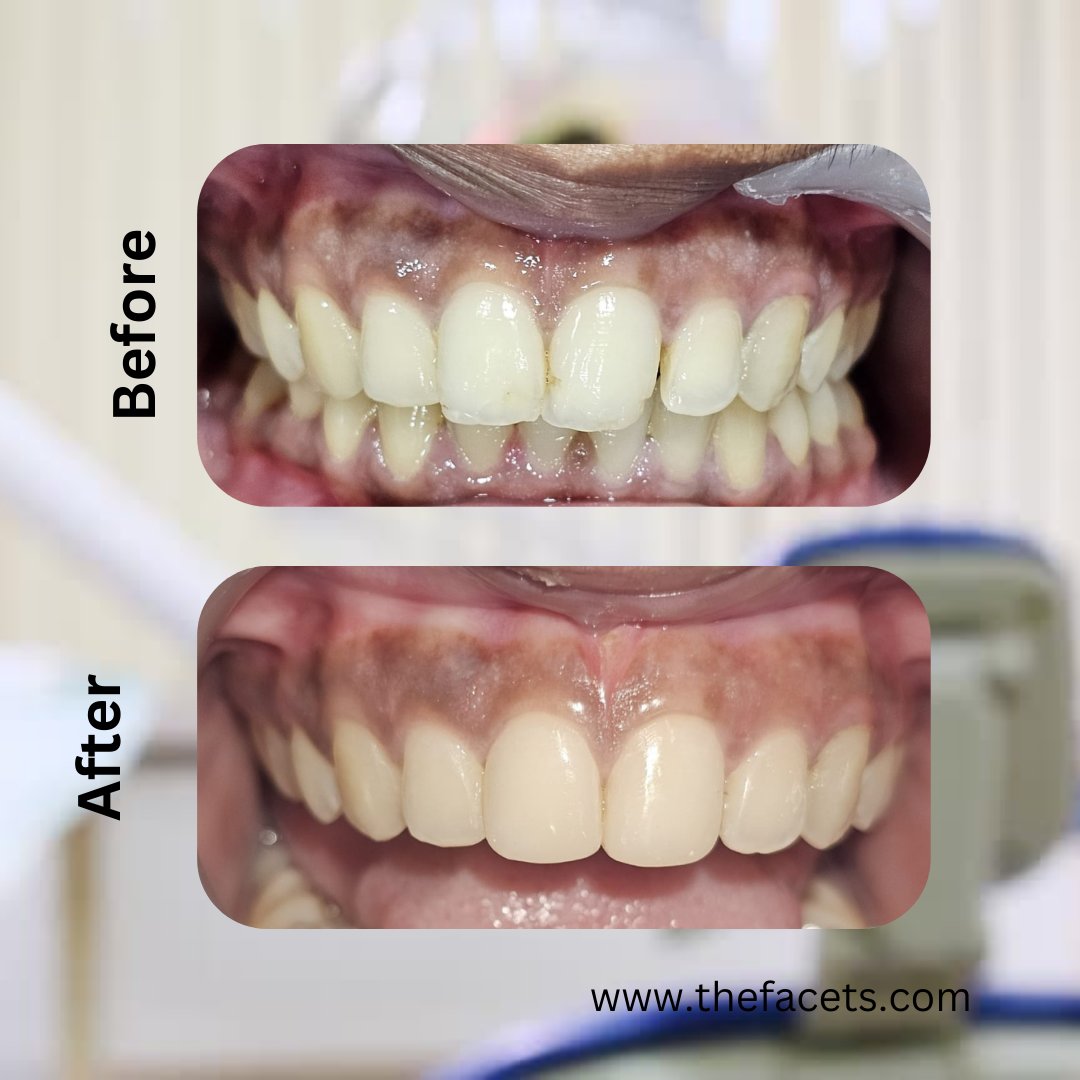 📍 Visit us at Facets Dental, Kochi
📞 Call/WhatsApp: +91 9020160160
🌐 Website: thefacets.com

#smilecorrection #CompositeVeneers #SmileMakeover #CosmeticDentistry #FacetsDental #KochiDentist #BestDentalClinic #SmileDesign #Veneers #PerfectSmile #DentalAesthetics