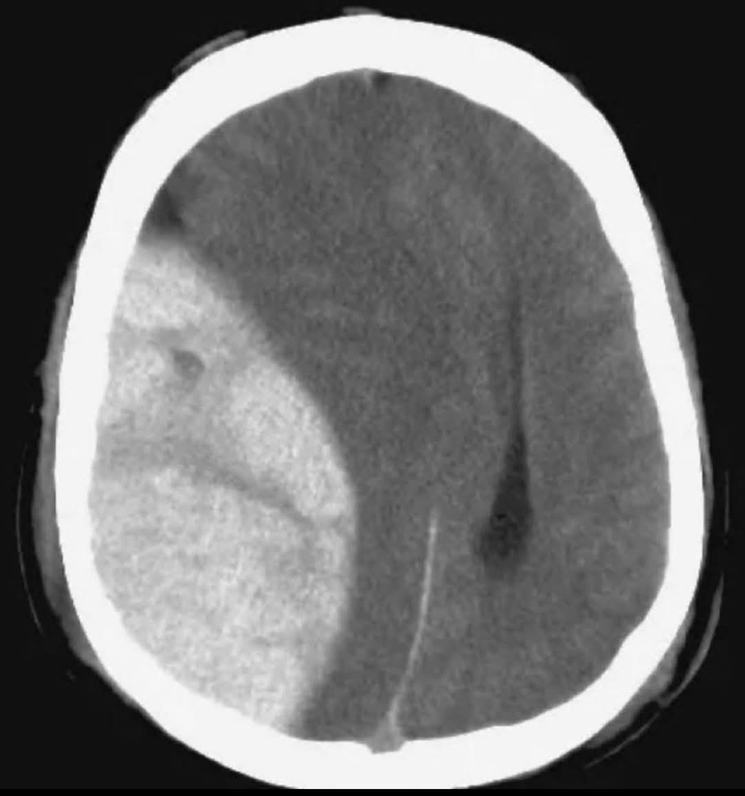 Neuromed_'s tweet photo. Patient presents after an accident with headache, vomiting, seizures, and neck pain. CT scan of the brain showed the following. What is your diagnosis? https://t.co/9LbAKQTM7O